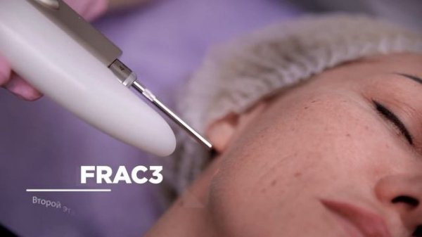 4D омоложение лица на лазере Fotona | Как проходит процедура | Клиника Vidnova