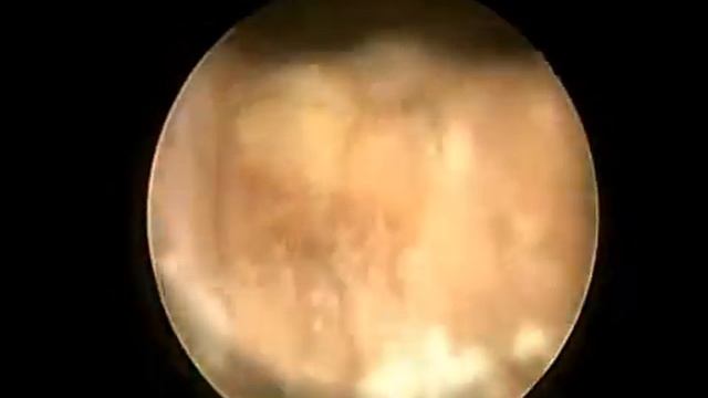 Би-полярный тур (Karl Storz) в Севастополе!!! смотреть онлайн