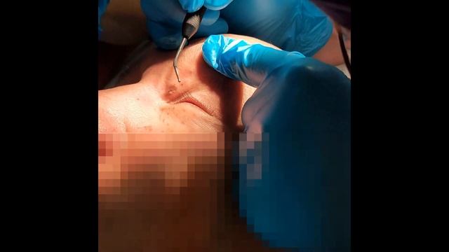 Удаление милиумов на веках смотреть онлайн