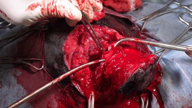 Удаление слухового хода буллы и главное лицевой нерв удалось найти.