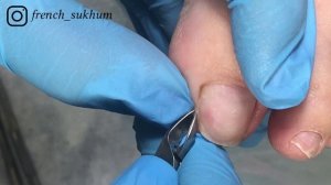 Обработка вросшего ногтя, подногтевая мозоль,  скрученные ногти.