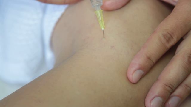 Склеротерапия вен: как это происходит смотреть онлайн