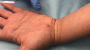 Криодеструкция бородавки