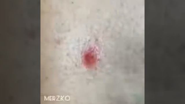 Удаление белого прыща смотреть онлайн