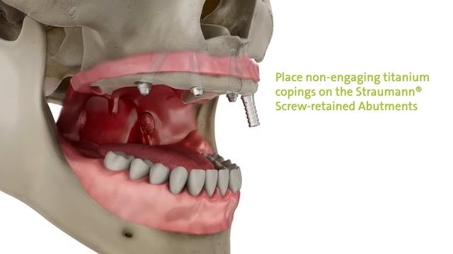 Straumann Pro Arch Step By Step Overview