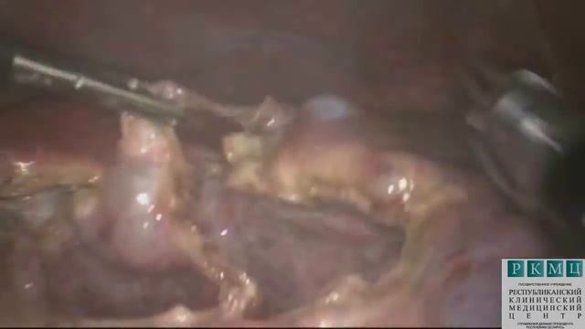 Лапароскопическая резекция кист печени