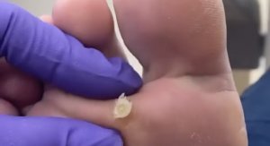 Стержневой мозоль?⚠️❗️??