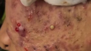 Выдавливание прыщей и черных точек на лице