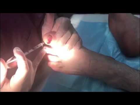 ВРОСШИЙ НОГОТЬ - операция лазерного удаления края ногтя. Клиника "Вектор". смотреть онлайн