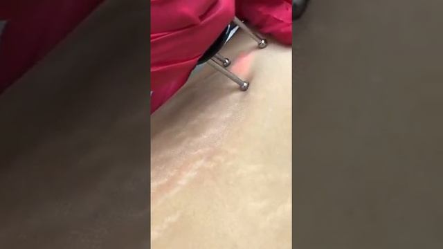 Шлифовка на эрбиевом лазере MCL 31 Dermablate (c системой дымоудаления) смотреть онлайн