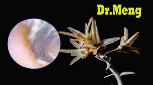 чистка ушей огнем,чистка ушей в индии,асмр чистка ушей