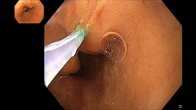 Бильрот 2, Стентирование холедоха смотреть онлайн