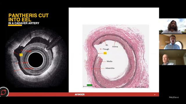 Seeing is believing: OCT Image Interpretation in Peripheral Artery Disease with Dr. Golzar смотреть онлайн