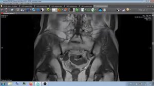 МРТ ОБСЛЕДОВАНИЕ . МАЛЫЙ ТАЗ .