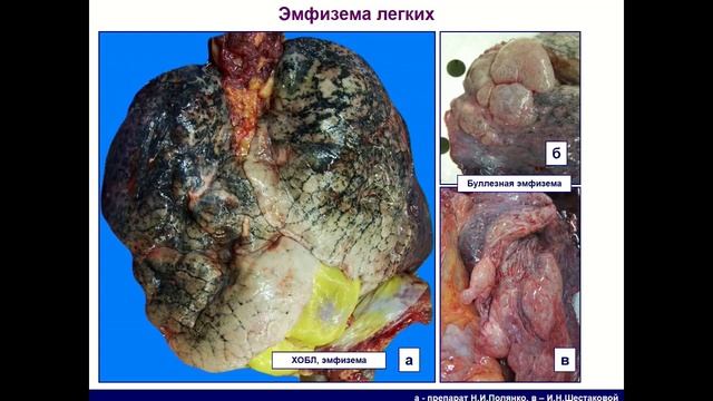 "Если нечем дышать, можем ли мы радоваться жизни?": пациент с ХОБЛ на амбулаторном приеме. 07.11.18 смотреть онлайн