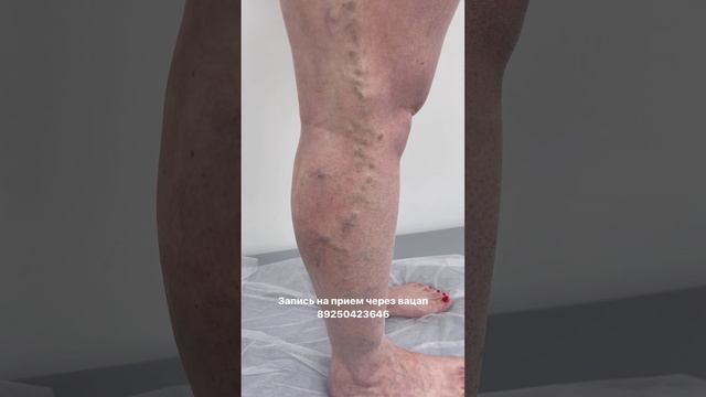 Нетипичная форма варикоза. Как лечить варикоз? Лечение варикоза. Флеболог. Флеболог Москва смотреть онлайн