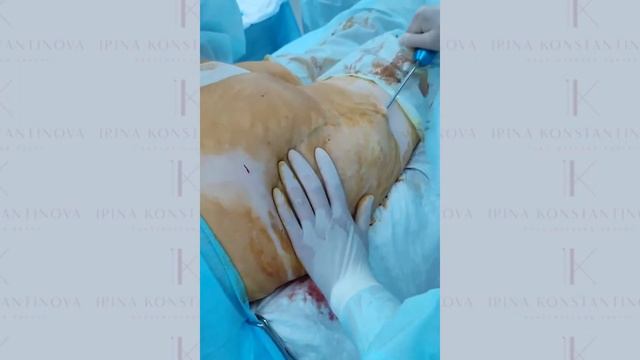 Липосакция зоны "Галифе". Как убираются всеми нелюбимые "ушки"? смотреть онлайн