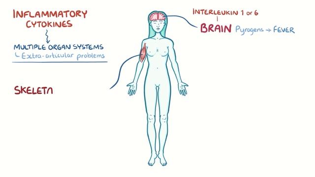 Rheumatoid arthritis - causes, symptoms, diagnosis, treatment, pathology смотреть онлайн