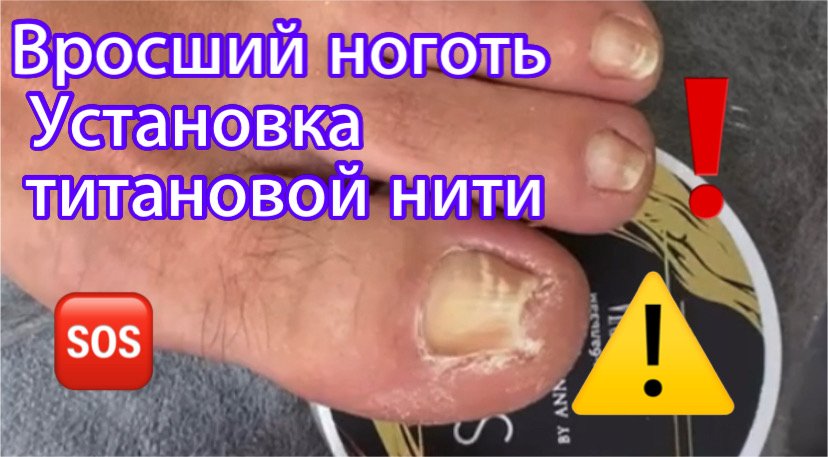 Вросший ноготь?⚠️❗️• Установка титановой нити?? смотреть онлайн