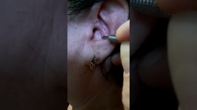 Лечебные зоны уха. Пищеварительная система. смотреть онлайн