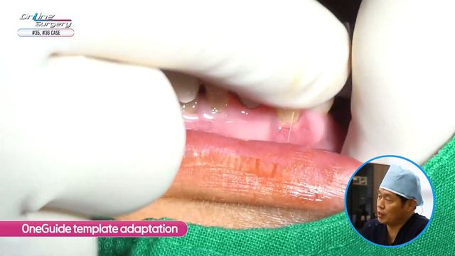 [Online Surgery] Placing Implants at #35, #36 Using OneGuide and GBR смотреть онлайн