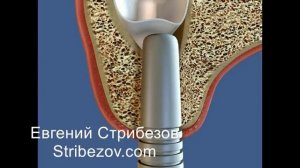 Закрытый синус лифтинг