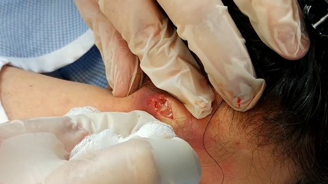 Drainage of Infected Epidermal Cyst смотреть онлайн