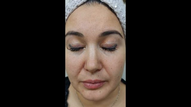 БЛЕФАРОПЛАСТИКА смотреть онлайн