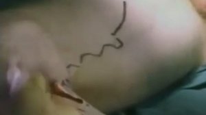 флебэктомия