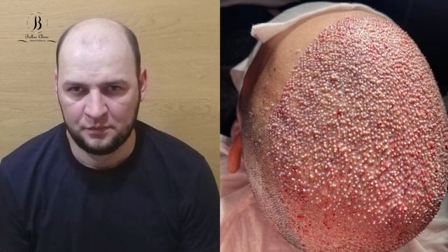 hair transplant in Bellus clinic in Istanbul смотреть онлайн