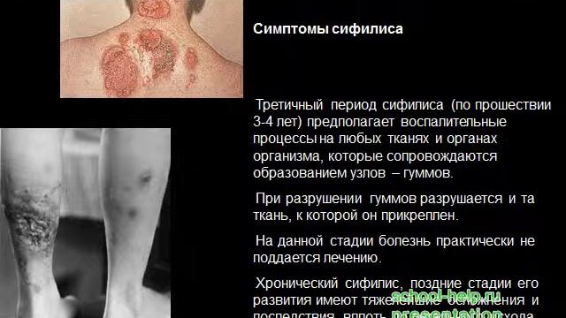 Презентация Болезни передаваемые половым путем смотреть онлайн
