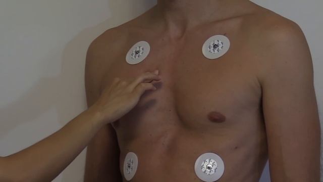 12 Lead ECG Placement of Electrodes | EKG Sticker Lead Procedure смотреть онлайн