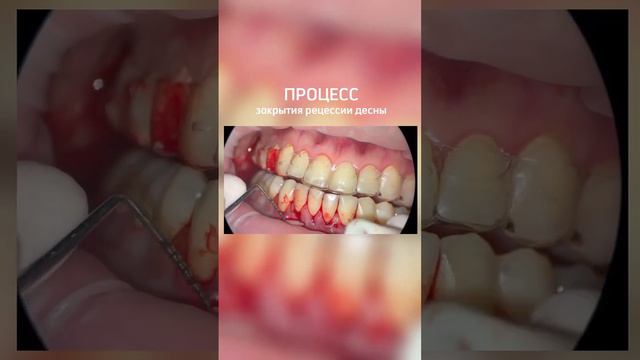 Процесс закрытия рецессии десны смотреть онлайн