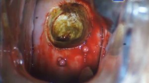 NEW Радиоволновая конизация шейки матки