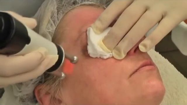 MCL30 Dermablate - Омоложение лица смотреть онлайн