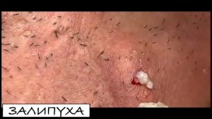ПРЫЩИ ВЫДАВЛИВАНИЕ. ВЫДАВЛИВАНИЕ ПРЫЩЕЙ. САМОЕ ЗАЛИПАТЕЛЬНОЕ ВИДЕО #прыщи #прыщивыдавливание #acne