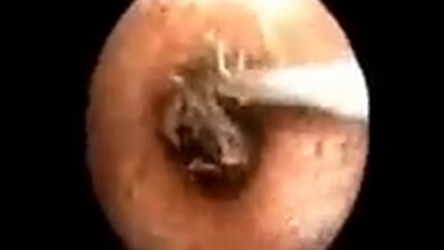 Жесть. Таракан в ухе.