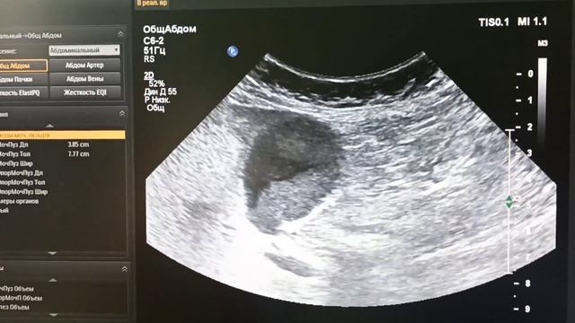 сладж в желчном пузыре, biliary sludge, Билиарный сладж смотреть онлайн