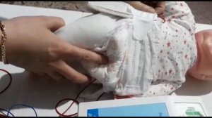 Электрофорез при дисплазии ТБС