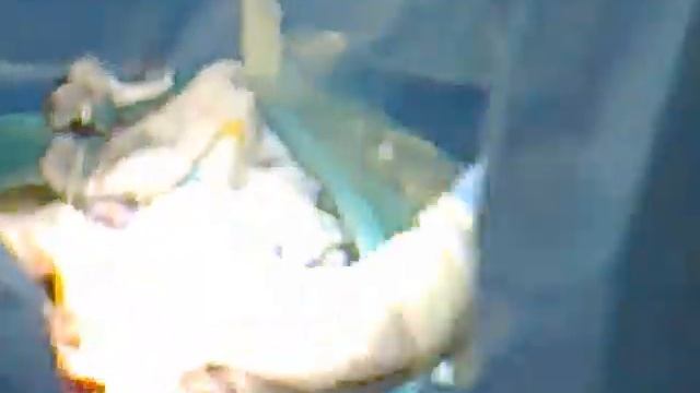 кесарево сечение 01. Ягодичное предлежание. caesarean section .Breech presentation смотреть онлайн