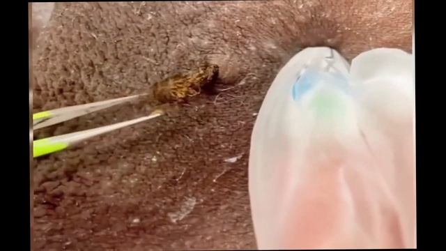 Вросший волос/ Удаление вросших волос в кожу / Вросший волос под кожей / Removing ingrown hairs смотреть онлайн