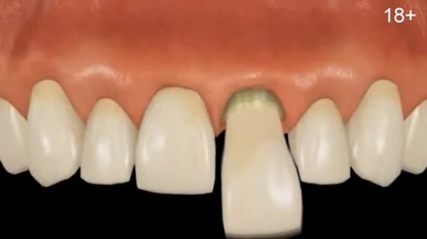 Можно ли ставить имплант сразу после удаления зуба? Одномоментная имплантация за 1 день!