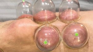 Массаж коленного сустава + постановка вакуумных банок.