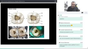 Вебинар  по эндодонтическим доступам