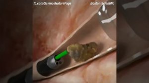 КАК ХИРУРГИ ДОСТАЮТ КАМНИ ИЗ ПОЧЕК