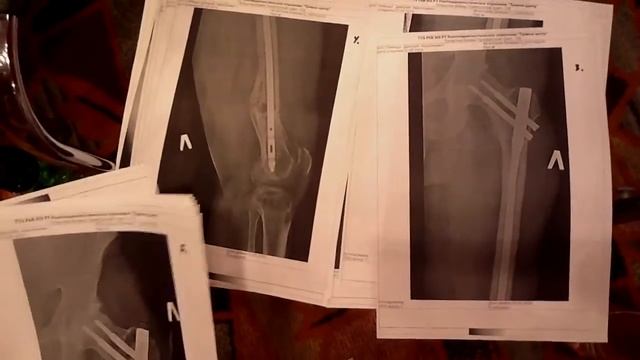 Рентгенолог города Казани делиться наблюдением своих пациентов, употреблящих воду с Х2О