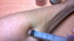 Как вытащить клеща! Как быстро вытащить клеща из тела человека! How to pull the tick!.