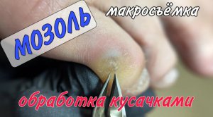 Обработка мозоли / мозоль на пальце