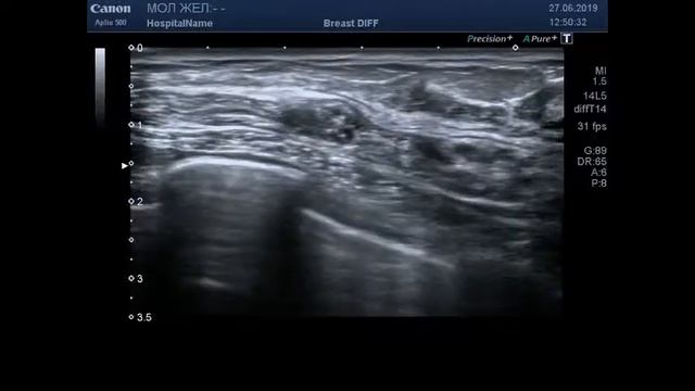 узи молочных желез смотреть онлайн