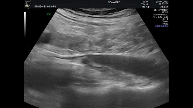 холедох смотреть онлайн